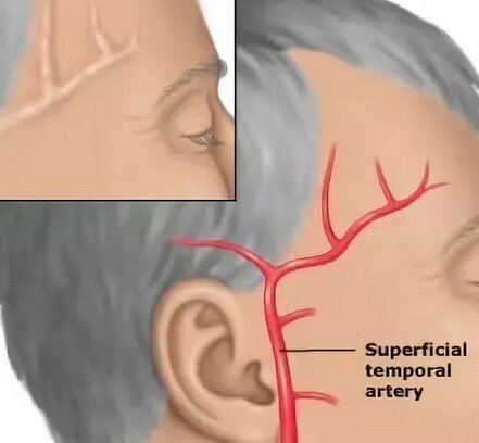 Вечером болит правый висок головы