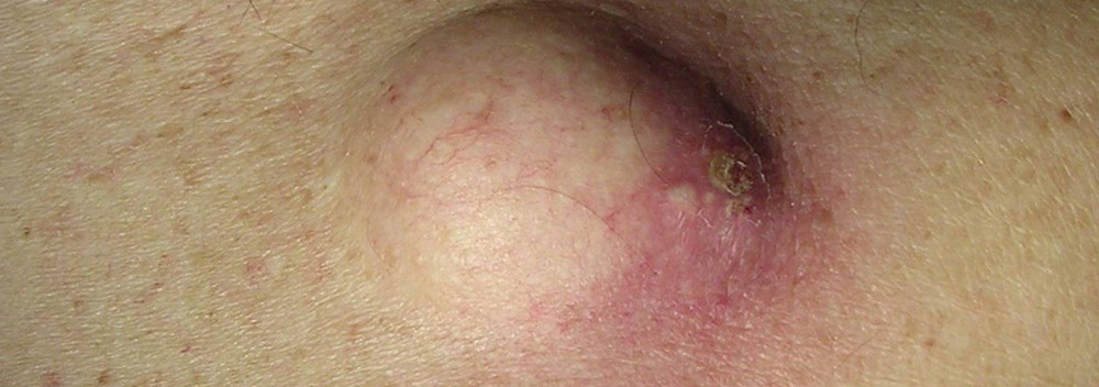 Выскочила шишка на спине болит