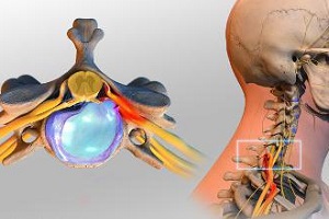 Грыжа шейного отдела позвоночника болит голова