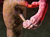 Аднексит Аднексит