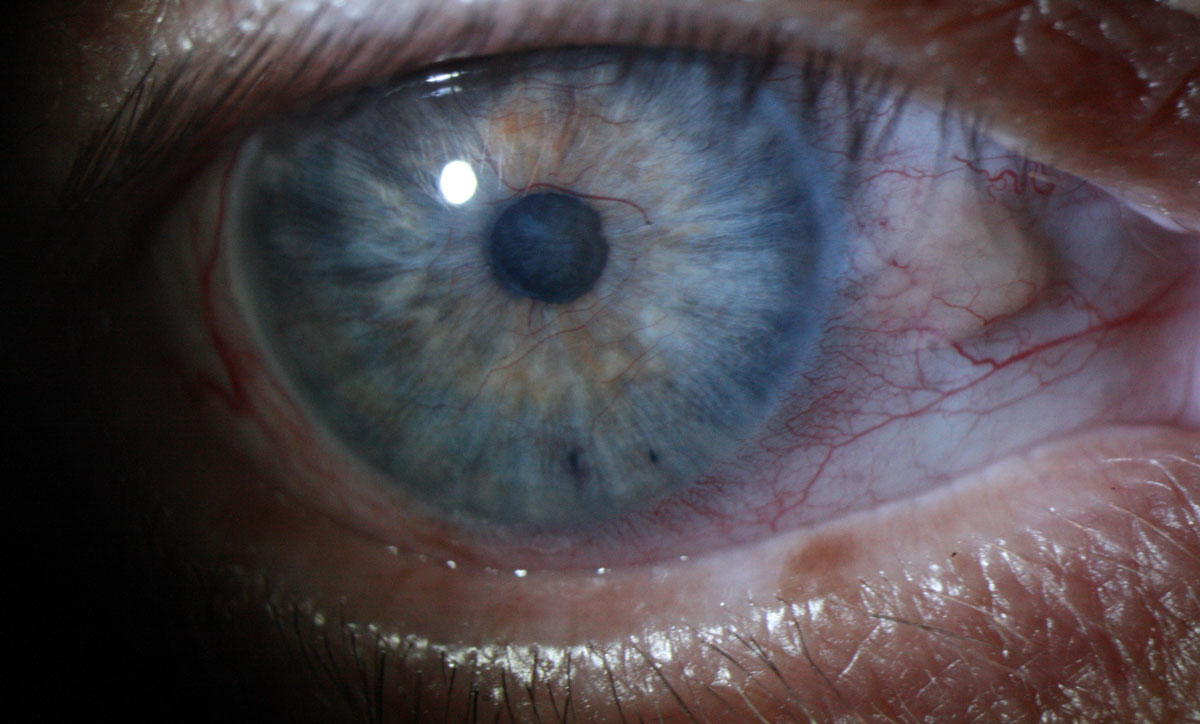 Эпидемический кератоконъюнктивит