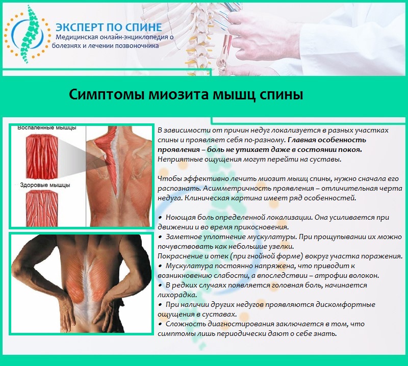 Симптомы миозита мышц спины