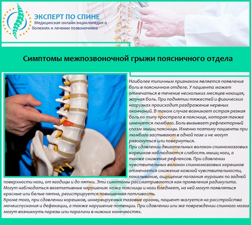 Симптомы межпозвоночной грыжи поясничного отдела