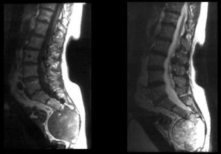 Выскочила шишка на спине болит