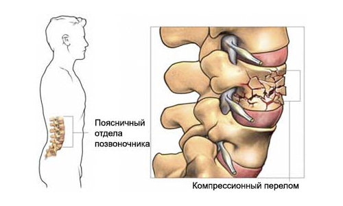 Компрессионный перелом позвоночника Компрессионный перелом позвоночника