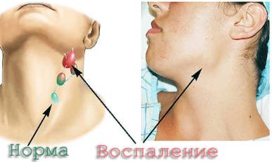 Болит спина может ли поднимается от этого температура
