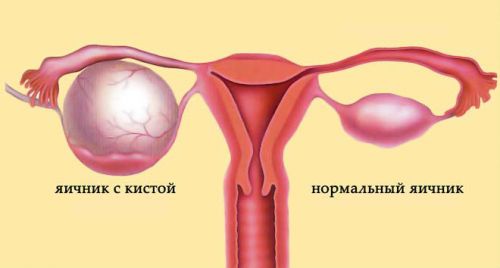 Киста яичника