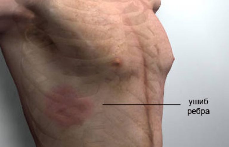боль ребра 2