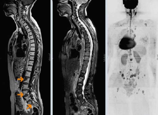 У меня рак матки поработала болит спина сильно