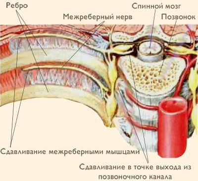 Межрёберная невралгия – возможная причина онемения спины Межрёберная невралгия – возможная причина онемения спины