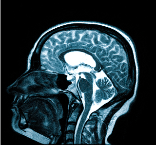 Необъяснимая цефалгия, возникающая регулярно и ухудшающая качество жизни не есть норма. Сильная боль -веский повод сделать МРТ головного мозга и не заниматься самолечением