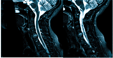 Боль при шейном остеохондрозе изначально возникает в затылке, а по мере прогрессирования патологии распространяется на лобно-височную область головы