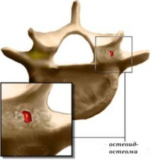 Выскочила шишка на спине болит