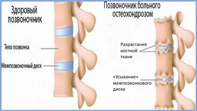 что такое остеохондроз