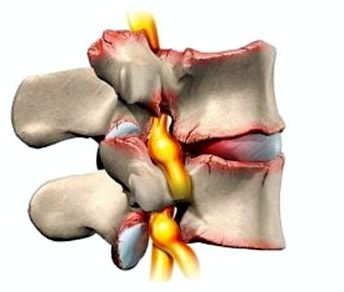 болит голова шея и левая рука