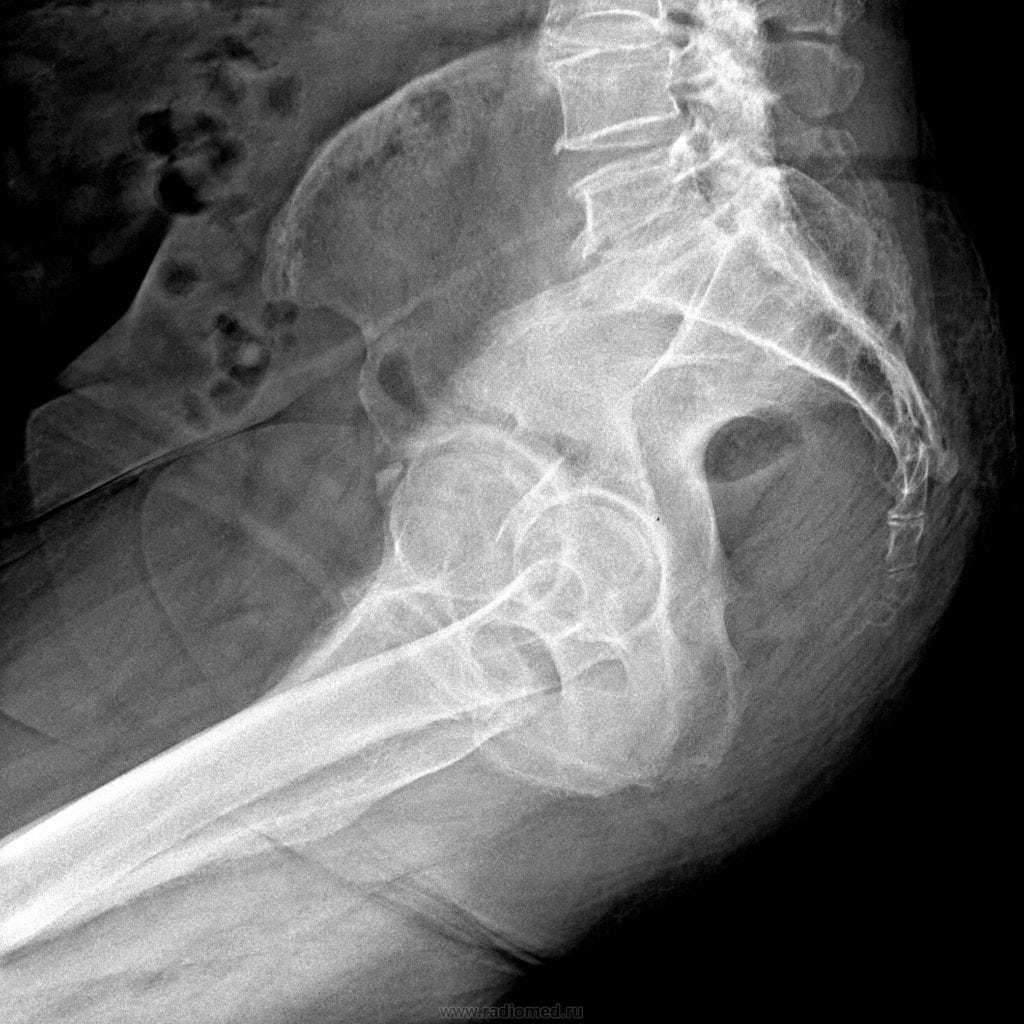 Болит спина у копчика народные средства